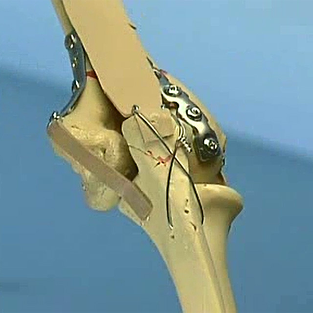 尺骨鹰嘴截骨入路肱骨远端关节内骨折内固定术