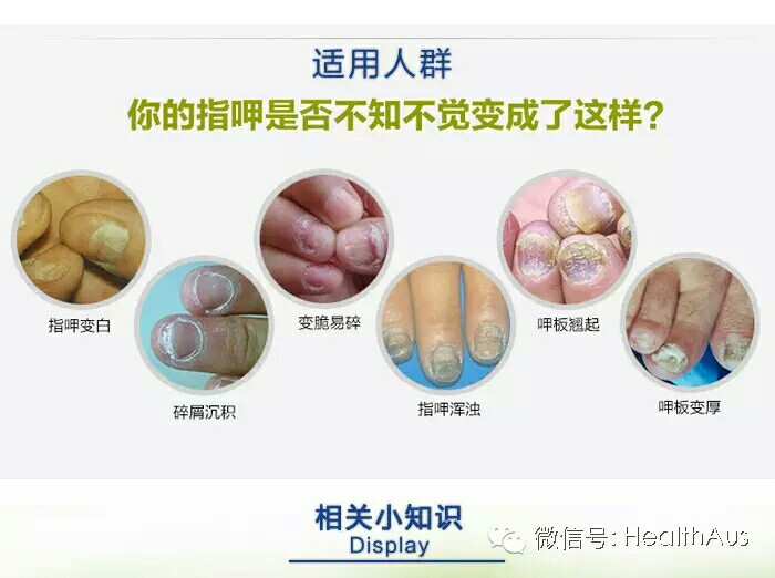 daktarin灰指甲治疗水