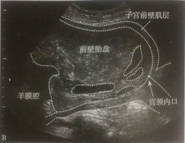 b:完全性前置胎盘(前壁型)