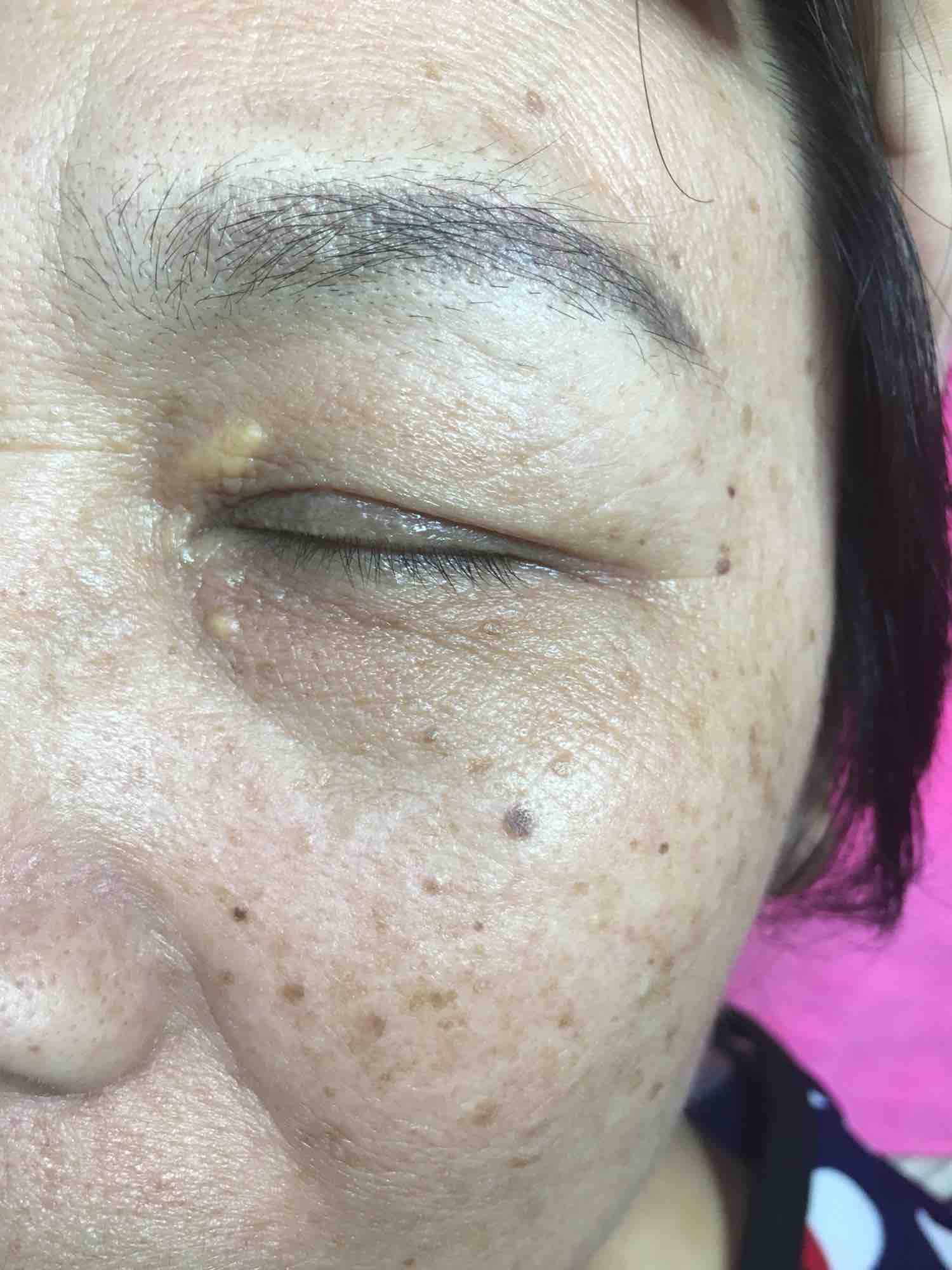 无痛不留疤 点痣 肉痣 扁平疣 肉刺…5元起!按实际