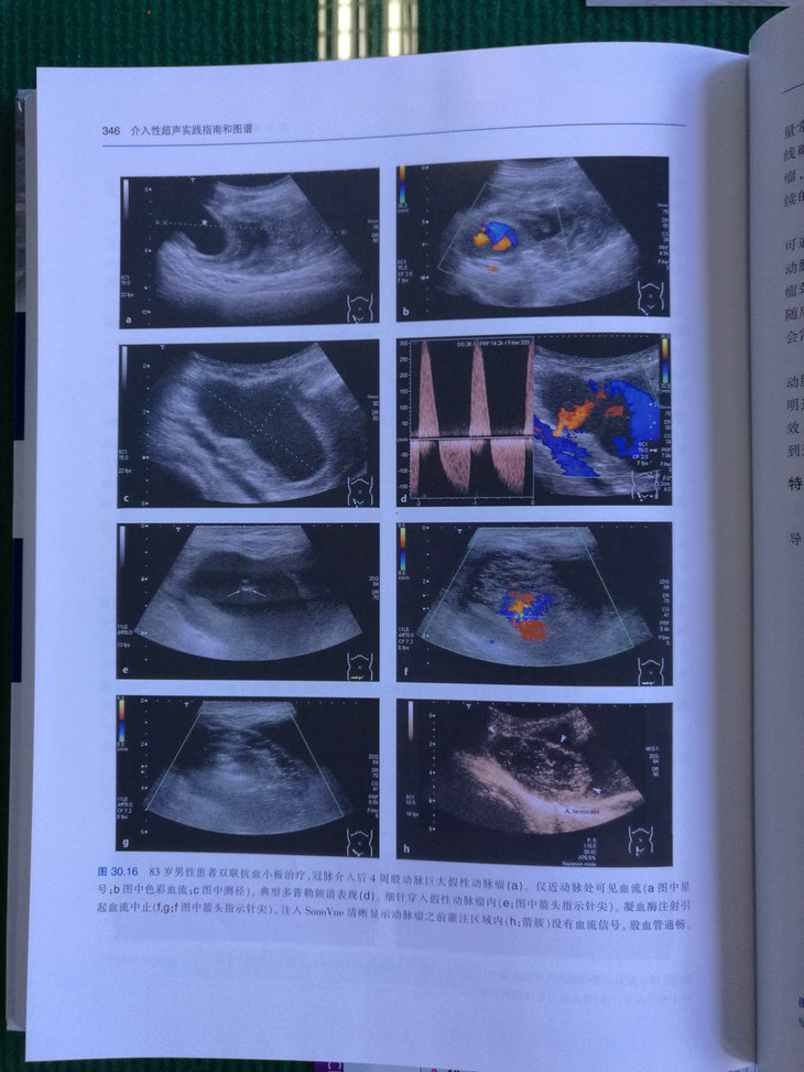 介入性超声实践指南和图谱