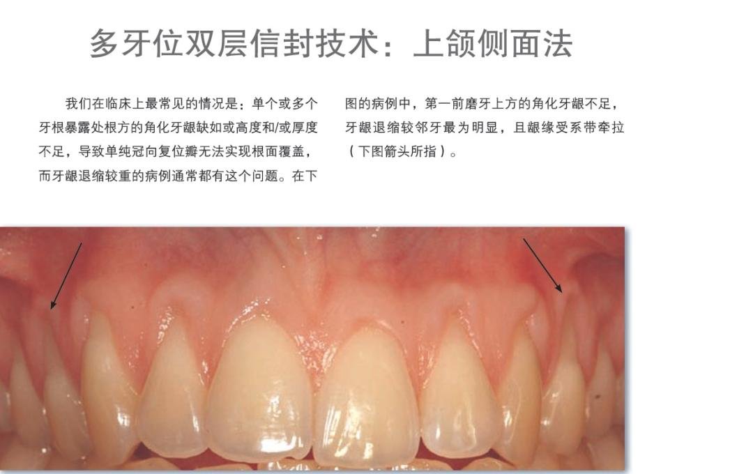 膜龈美学手术精要