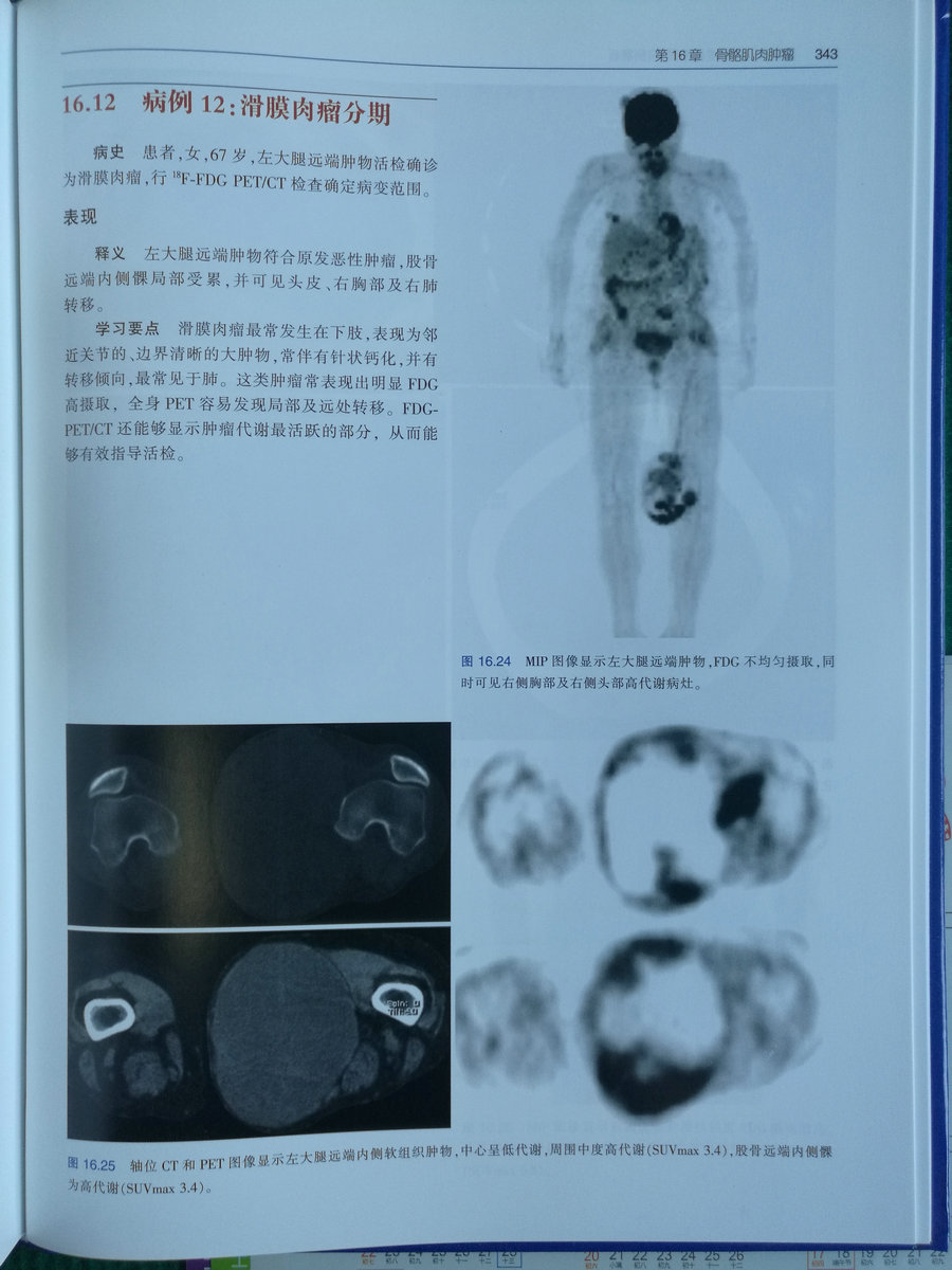 zhongliu pet/ct成像图谱:病例解析