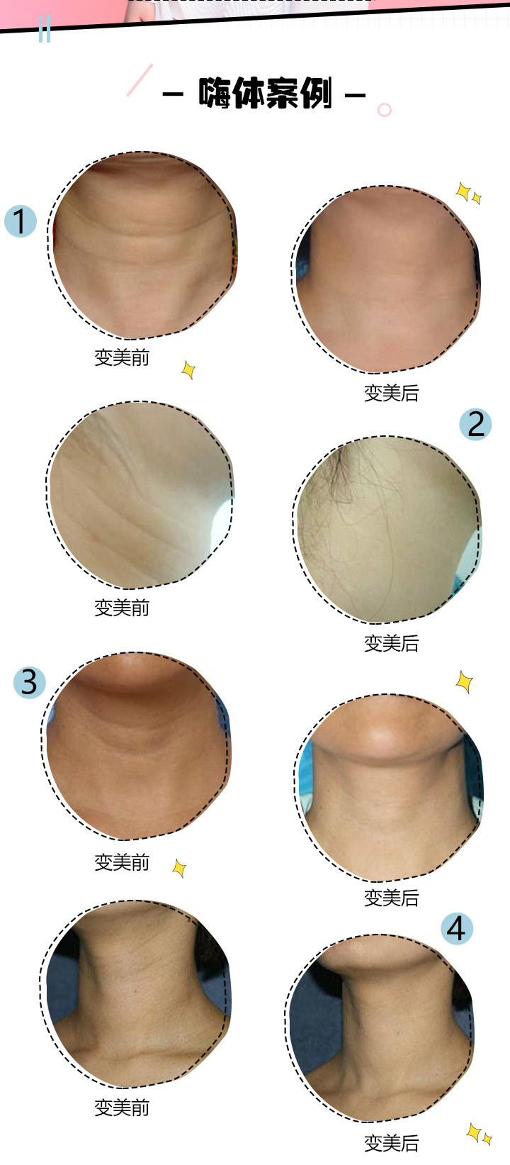【嗨体去颈纹】嗨体颈纹针,改善颈纹,还你天鹅美颈.
