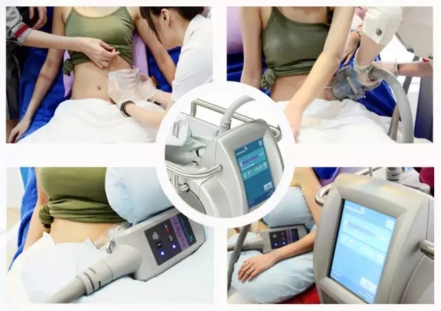 【支持海外分期购】【冷冻溶脂】美国酷塑coolsculpting冷冻减脂 哈佛