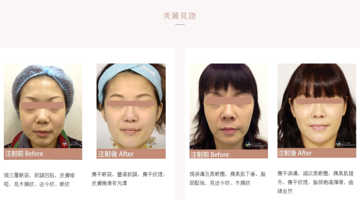 derma veil注射童颜针【美一医学美容】 祛皱木偶纹嘴角纹下巴塑形