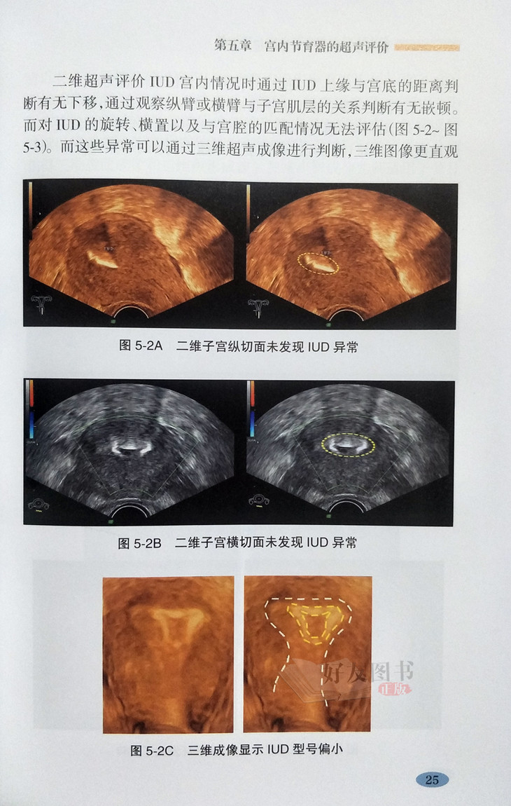 《宫内节育器三维超声图谱》