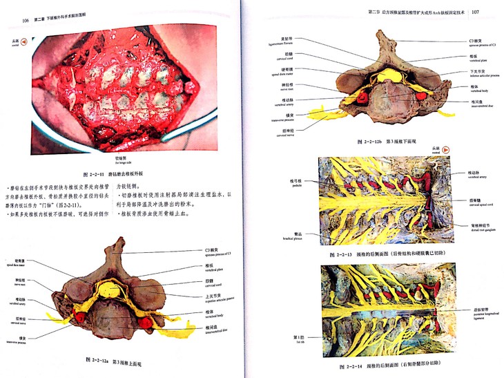 第七节 旁正中腹膜外腰椎显露及前方椎间盘切除椎体融合技术 第八节