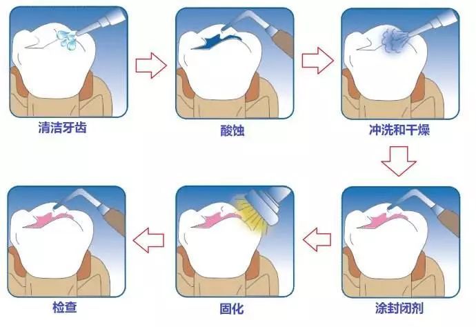 无痛牙周仪洗牙 儿童窝沟封闭/涂氟等口腔健康福利来啦!