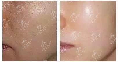 安肌Baby无针水光 商品图3