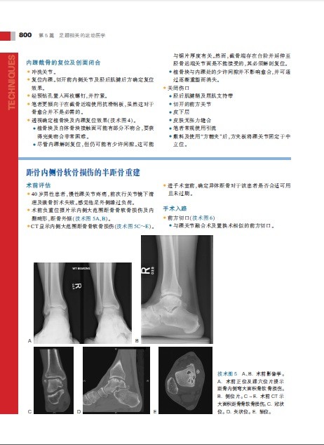 第1篇 前足 第1章 跖骨远端chevron截骨术:方法1 第2章 跖骨远端