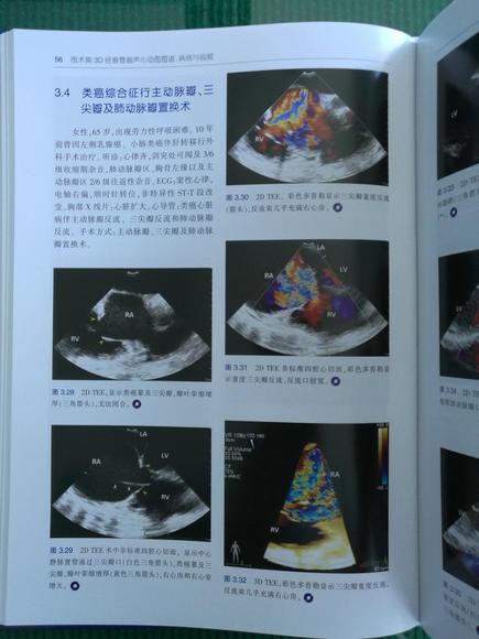 围术期3d经食管超声心动图图谱:病例与视频