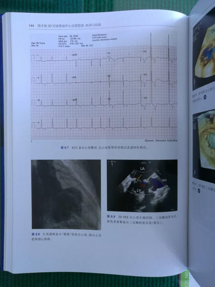围术期3d经食管超声心动图图谱:病例与视频