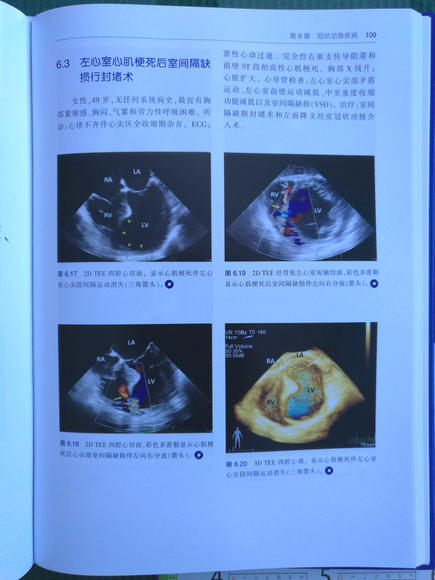 围术期3d经食管超声心动图图谱:病例与视频