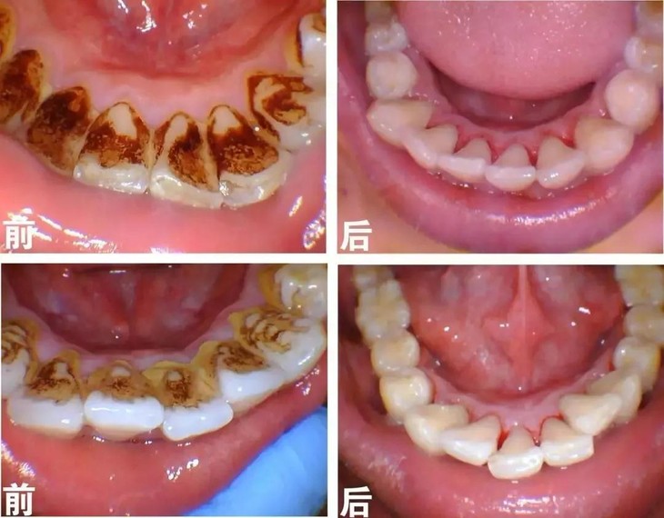 洗牙前后对比