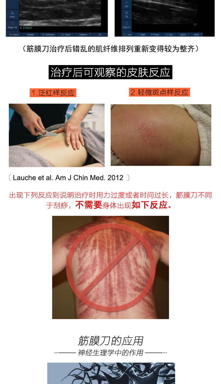 athlax iastm肌筋膜刀理疗工具筋膜刀松解刀软组织辅助松解技术
