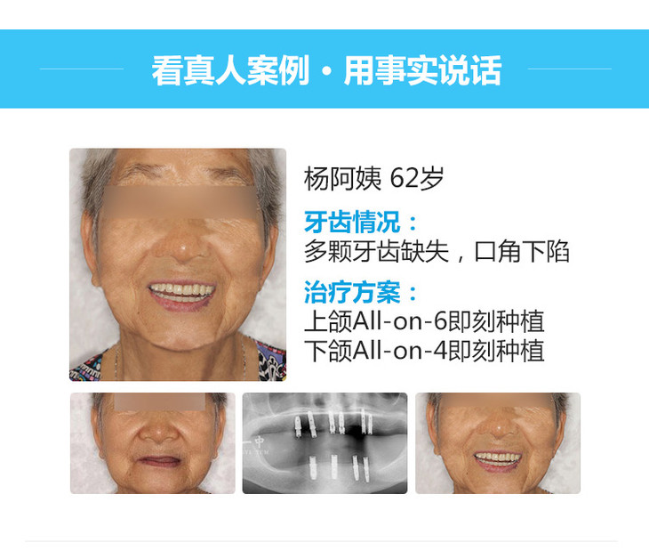 【韩国进口奥齿泰种植体】含基台 牙冠