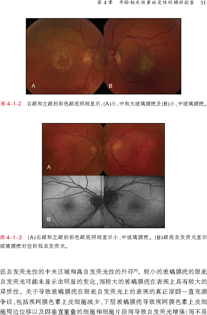 年龄相关性黄斑变性:最新诊断与治疗