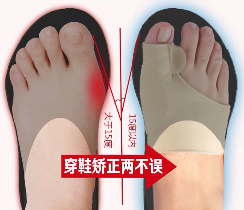 舒适无痛矫正带,拯救大拇指外翻!