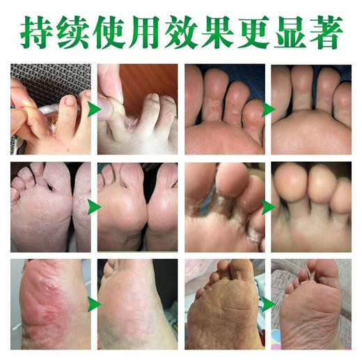 【特惠组合】——广舒平护足康草本抑菌组合 商品图5