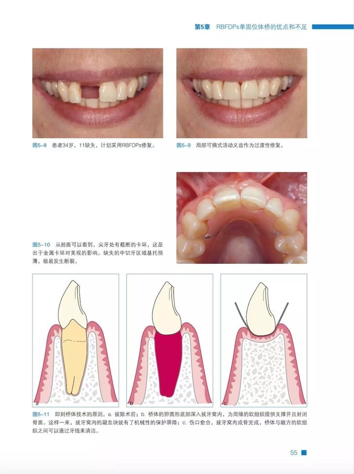 【现货】《树脂粘结式固定桥》