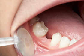 缺牙不补，你的牙齿可能会越掉越快 