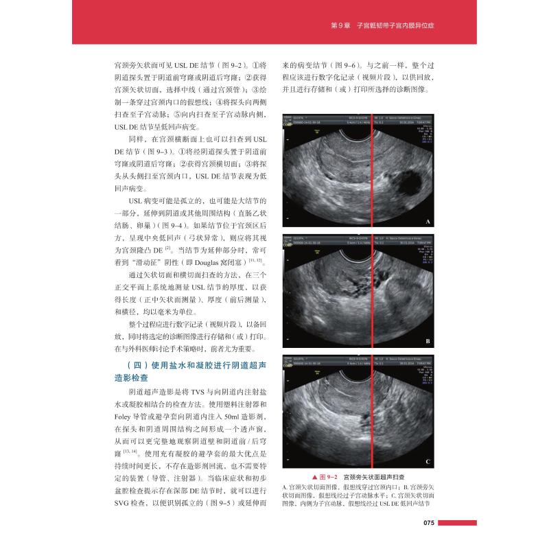 子宫内膜异位症超声诊断