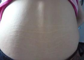 肾虚纹是什么？你有吗？