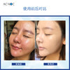 【口碑推荐】ACNOC艾克诺山竹祛痘膏 商品缩略图3