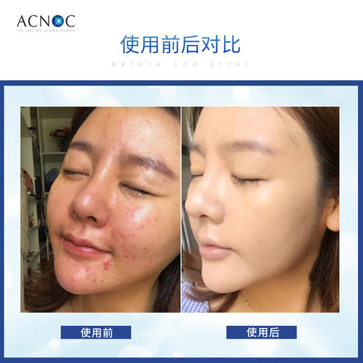 【口碑推荐】ACNOC艾克诺山竹祛痘膏 商品图3