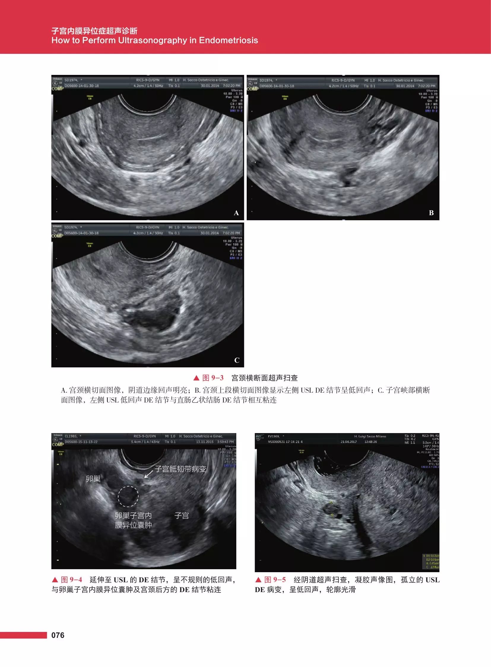 子宫内膜异位症超声诊断 袁丽君 张莉译 国内外妇科领域关于子宫内膜