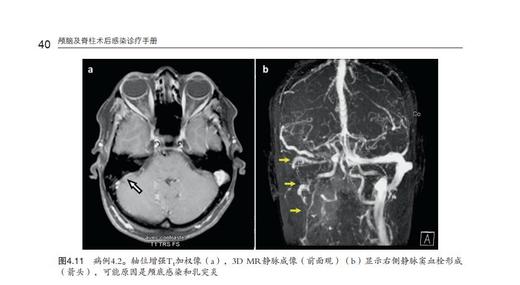 《颅脑及脊柱术后感染诊疗手册》 商品图3
