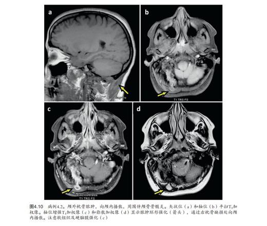 《颅脑及脊柱术后感染诊疗手册》 商品图2