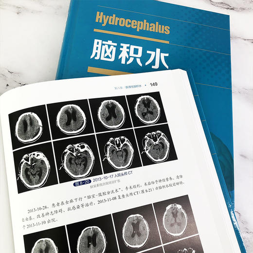 脑积水 商品图5