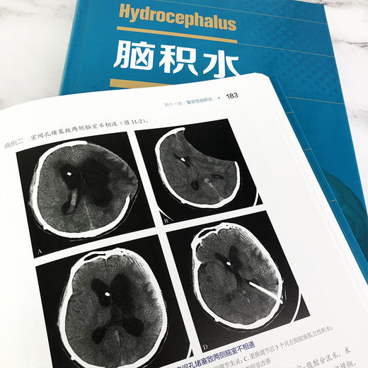 脑积水 商品图6