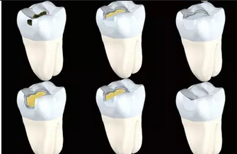 后牙激光美学分层充填/后牙瓷化纳米树脂充填(颗)