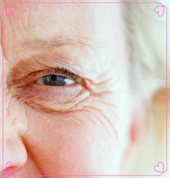 【肉毒素祛鱼尾纹】不开刀横扫鱼尾纹,眼周紧致让时光逆转, 无需手术