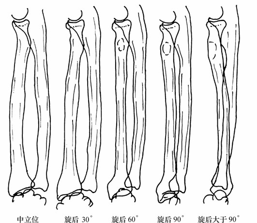 (图14-7) 肘侧位x线片前臂旋后程度确定标准图
