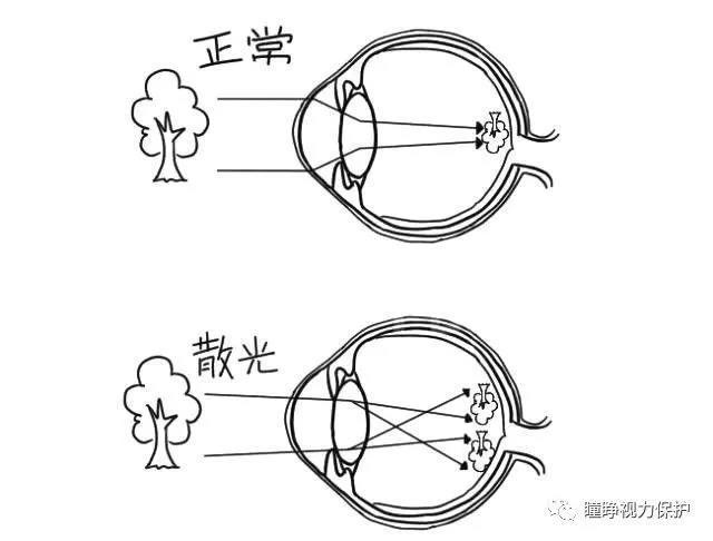 或者,以后只能这样悲催的看书了…… ▼ ▼ 散光是指屈光系统表面