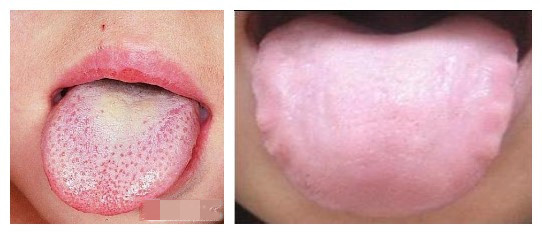 湿热 体格瘦弱,肉疏松:寒湿 脸色潮红:湿热 脸色萎黄:寒湿 舌红苔黄