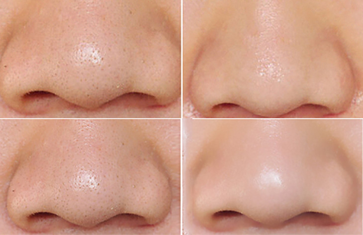 去除黑头的前后