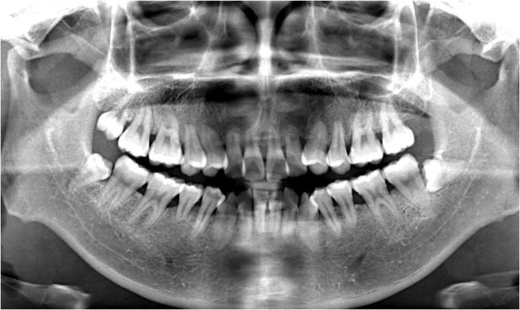 4折】68元拿下华西口腔专家脱敏洁牙 拍全景片 儿童进口涂氟 检查及出