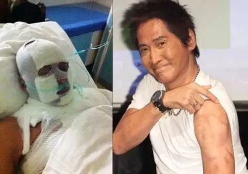 (齐秦拔火罐被烧伤)