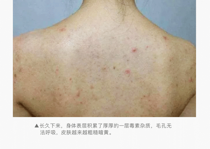 日本樱美堂美背皂 | 身体深彻祛污 告别痘痘,粉刺,暗黄