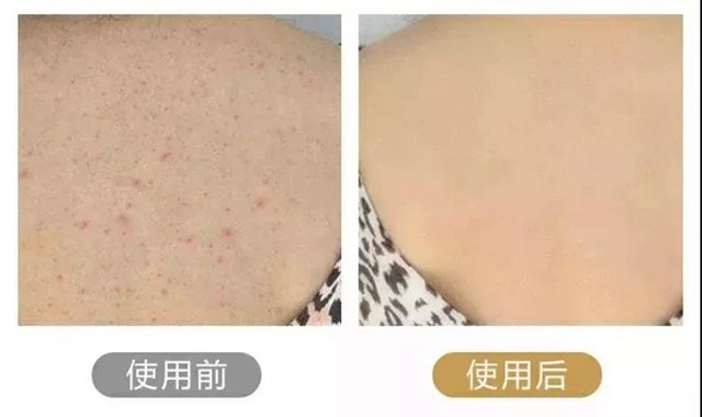 污垢堵塞毛孔之后, 搓澡巾要想带走污垢, 必须猛烈的来回揉搓, 不