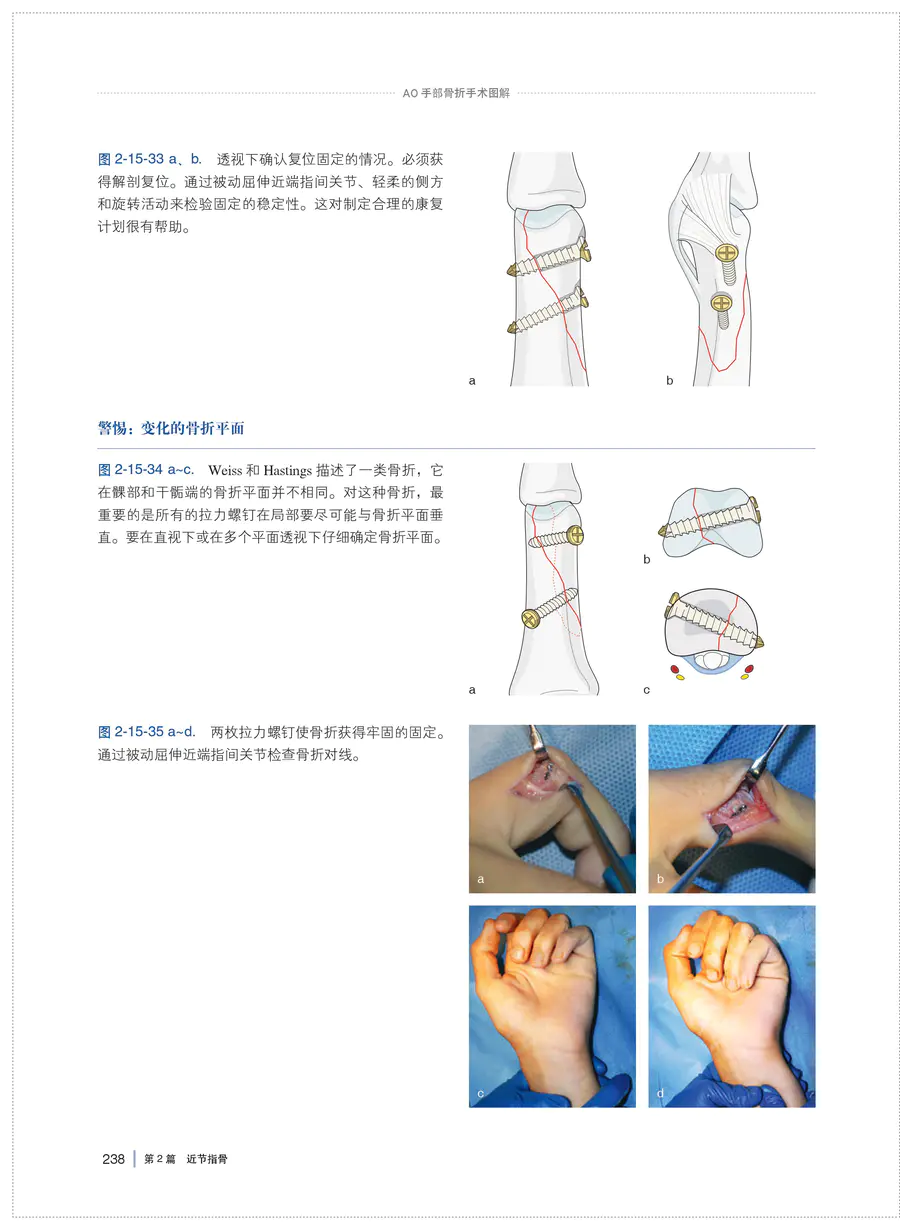 Ao手部骨折手术图解主译 刘璠陶然上科出版