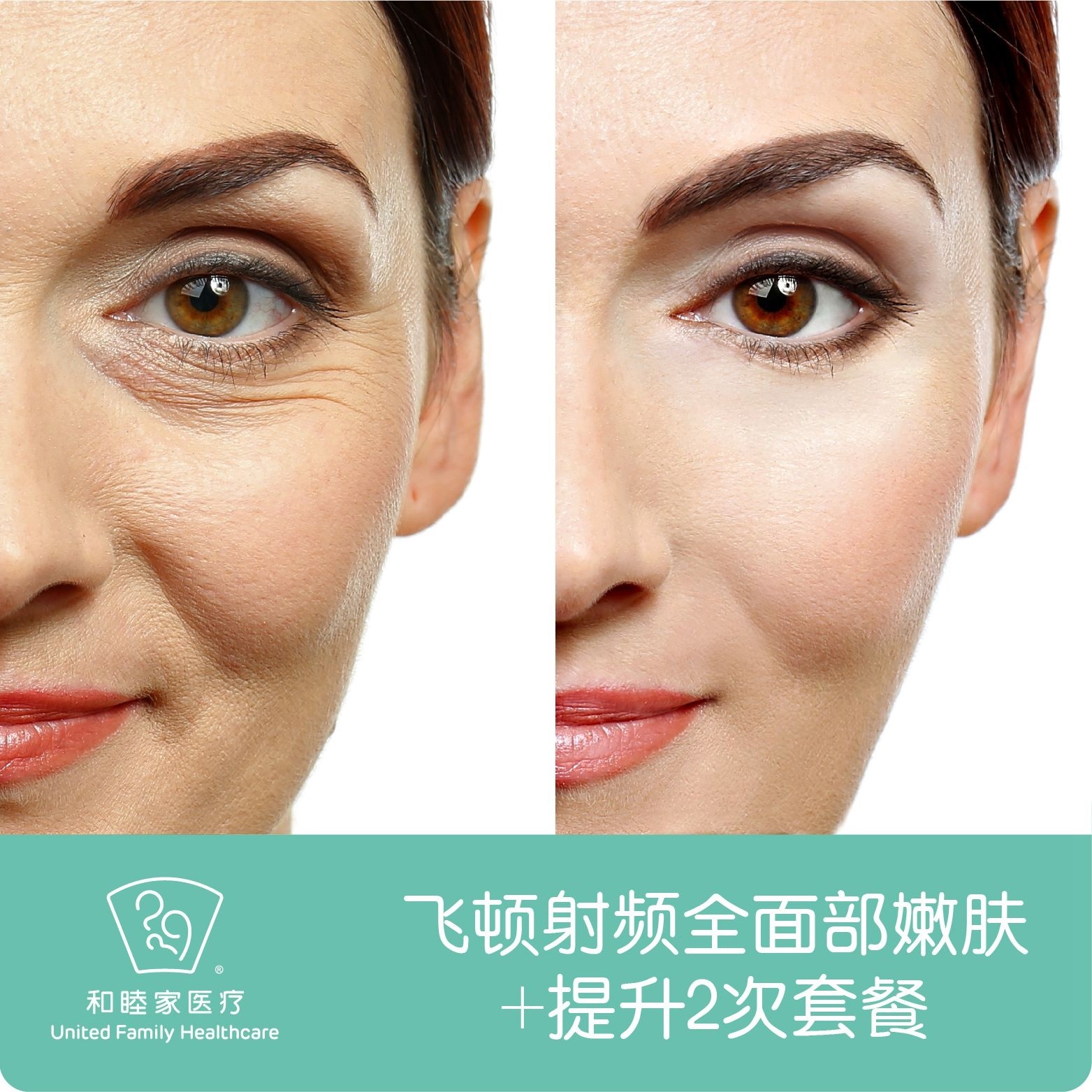 飞顿射频全面部嫩肤 提升2次套餐