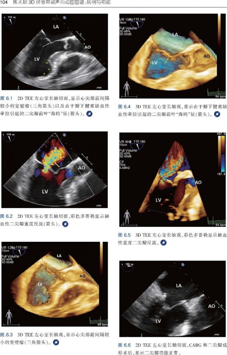 围术期3d经食管超声心动图图谱:病例与视频