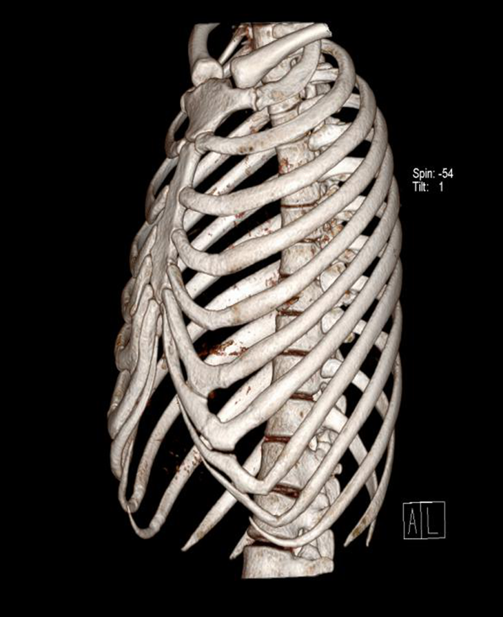 男性肋软骨钙化常是肋软骨上下缘首先钙化,自肋骨端向胸骨端延
