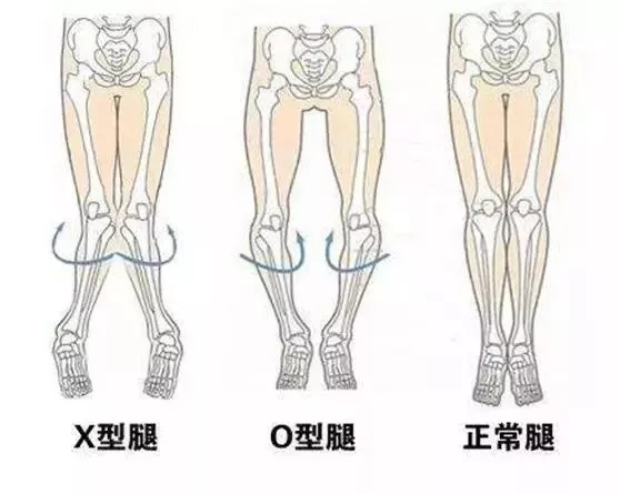 六岁儿童正常腿型判断图片